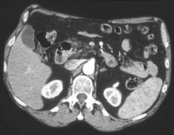 Fatty Infiltration of the Pancreas - CTisus CT Scan