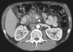 Pancreatic Cancer - CTisus CT Scan