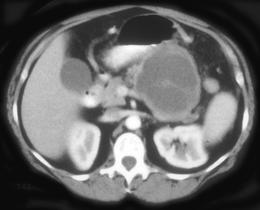 Cystadenoma of the Pancreas - CTisus CT Scan