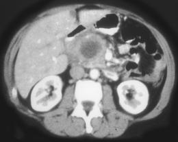 Pseudocyst - CTisus CT Scan