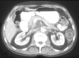 Infiltration of the Superior Mesenteric Artery (SMA) Due to Prior Pancreatitis - CTisus CT Scan