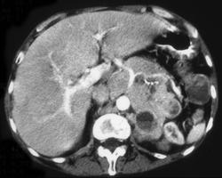 Islet Cell Tumor Infiltrates the Celiac Axis - CTisus CT Scan