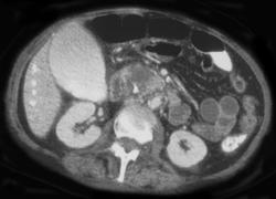 Pancreatic Cancer - CTisus CT Scan