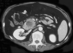 Pancreatic Cancer Encases the Superior Mesenteric Vein (SMV) - CTisus CT Scan