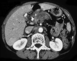 Pancreatic Cancer - CTisus CT Scan