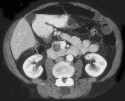 Cystadenoma of the Pancreas - CTisus CT Scan