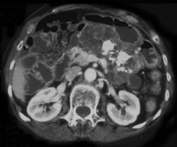 Nonfunctioning Islet Cell Tumor - CTisus CT Scan