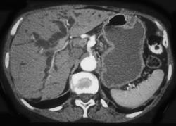 Dilated Common Bile Duct (CBD) Due to Pancreatic Cancer - CTisus CT Scan