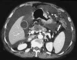 Pancreatic Cancer With Malignant Ascites - CTisus CT Scan