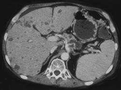 Infiltrating Pancreatic Cancer - CTisus CT Scan