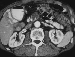 Small Recurrent Pancreatic Cancer - CTisus CT Scan