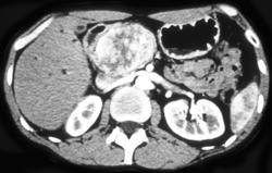 Islet Cell Tumor - CTisus CT Scan