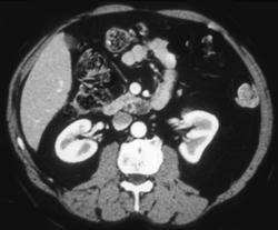 Small Adenocarcinoma of the Pancreas - CTisus CT Scan