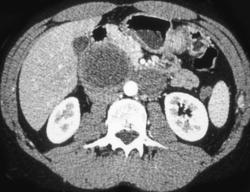 Pancreatic Pseudocysts - CTisus CT Scan