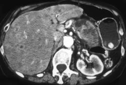 Pancreatic Carcinoma With Liver Metastases - CTisus CT Scan