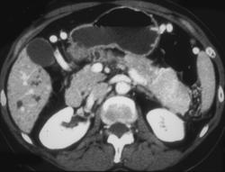 Islet Cell Tumor- Pancreatic Tail - CTisus CT Scan