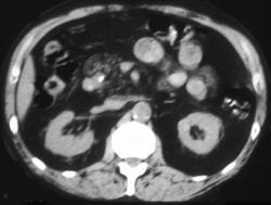 Pancreatitis With A Stone in the Distal Common Bile Duct (CBD) - CTisus CT Scan