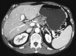 Pancreatic Cancer With Vessel Invasion - CTisus CT Scan