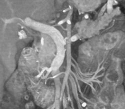 Pancreatic Cancer Without Portal Vein Involvement - CTisus CT Scan