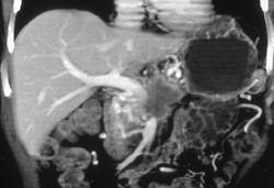 Carcinoma of the Pancreas Invades Portal Vein/splenic Vein Confluence. Nice Collaterals Seen - CTisus CT Scan