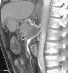 Carcinoma of the Pancreas Displaces Celiac Artery and SMA - CTisus CT Scan