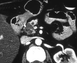 Pancreatic Cancer Vs Intraductal Papillary Mucinous Tumor (IPMT) - CTisus CT Scan