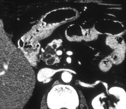 Cystic Component Was Intraductal Papillary Mucinous Tumor (IPMT) With A Carcinoma Adjacent to It - CTisus CT Scan