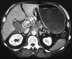 Cavernous Transformation of the Portal Vein Due to Invasive Pancreatic Cancer - CTisus CT Scan