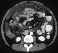 Carcinoma of the Tail of the Pancreas With Carcinomatosis - CTisus CT Scan