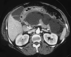 Pancreatic Abscess - CTisus CT Scan