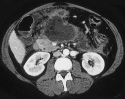 Pancreatic Abscess With Portal Vein Thrombosis - CTisus CT Scan