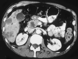 Pancreatic Cancer With Liver Metastases - CTisus CT Scan