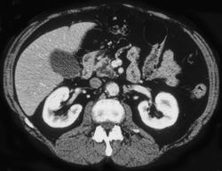 Cystic Tumor Pancreatic Head, Intraductal Papillary Mucinous Tumor (IPMT) - CTisus CT Scan