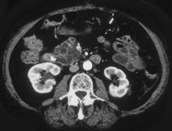 IntraduCTAl Mucinous Tumor of the Pancreas - CTisus CT Scan