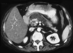 Pseudocyst - CTisus CT Scan