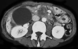 Dilated Common Bile Duct (CBD) and Intrahepatic Ducts Due to Pancreatic Cancer - CTisus CT Scan