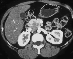 Unusual Hypovascular Islet Cell Tumor - CTisus CT Scan