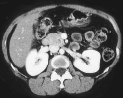 Dual Phase of Subtle Islet Cell Tumor - CTisus CT Scan