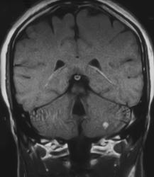 Von Hippel Lindau Syndrome With Pancreatic Cysts and Hemangioblastoma - CTisus CT Scan