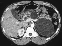 Pancreatic and Renal Cysts in A Patient With Von Hippel Lindau Syndrome - CTisus CT Scan