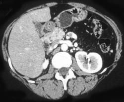 Fatty Replaced Pancreatic Tail Due to An Islet Cell Tumor (incredible Case!) - CTisus CT Scan