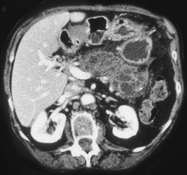 Intraductal Papillary Mucinous Tumor (IPMT) of the Entire Pancreas - CTisus CT Scan