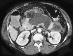 Pancreatic Abscess With Drain in Place - CTisus CT Scan