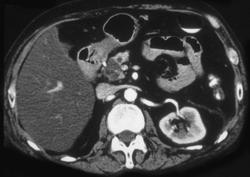 Intraductal Papillary Mucinous Tumor (IPMT) - CTisus CT Scan