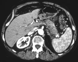 Pancreatic Cancer Occludes the Splenic Vein. Note Collaterals - CTisus CT Scan