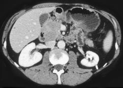 Pancreatic Cancer - CTisus CT Scan