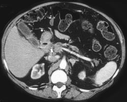 Pancreatic Cancer Invades the Hepatic Artery - CTisus CT Scan