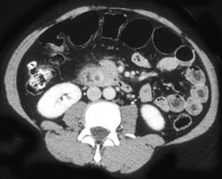 Ampullary Cancer - CTisus CT Scan