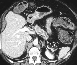 1.5 Cm Pancreatic Cancer - CTisus CT Scan