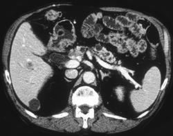 Pancreatic Cancer With Liver Metastases - CTisus CT Scan